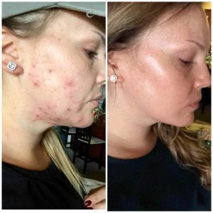 IMANOK 10MG/30CAPS - ACNE CURE IMANOK 10MG/30CAPS - ACNE CURE